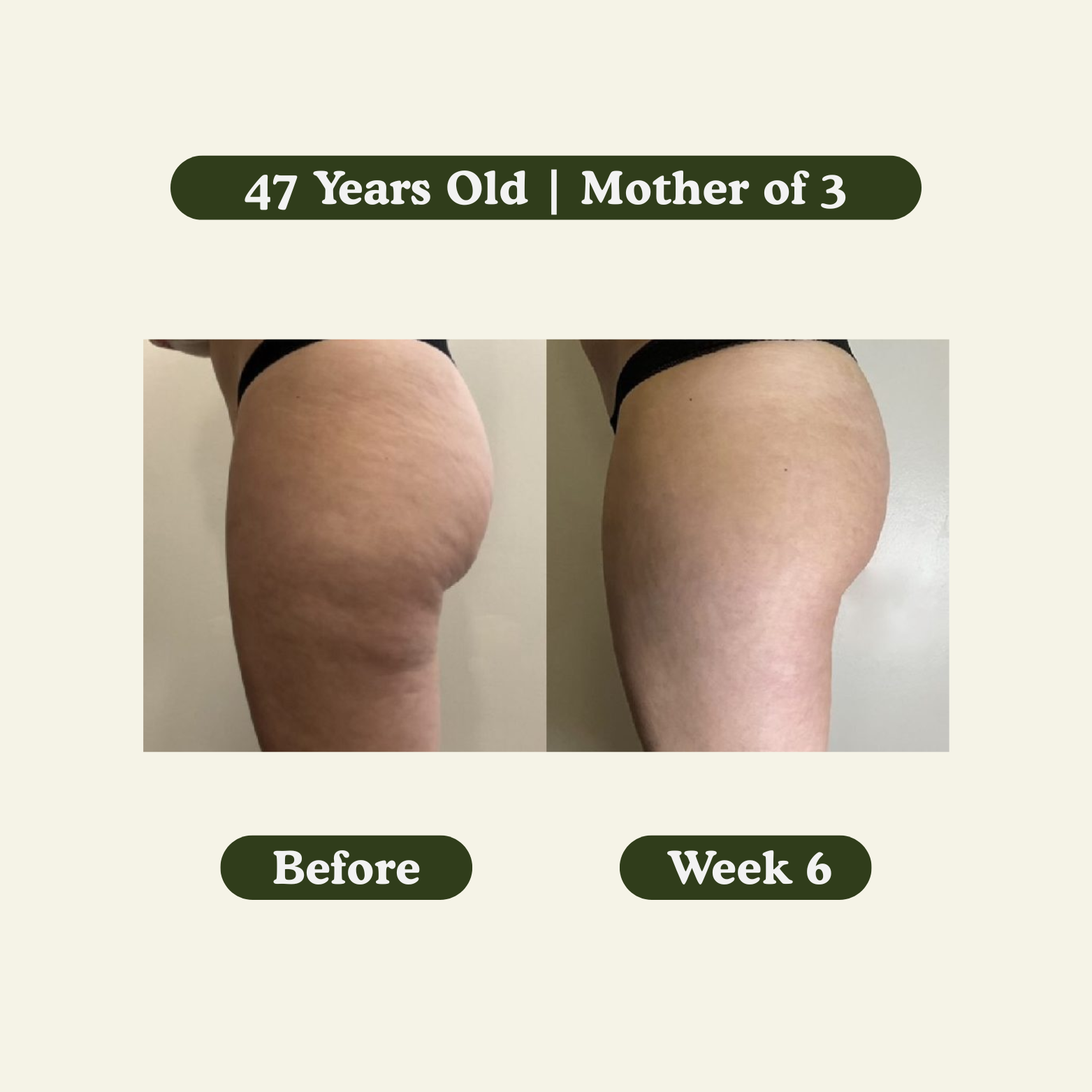 Anti-Cellulite Massage Oil