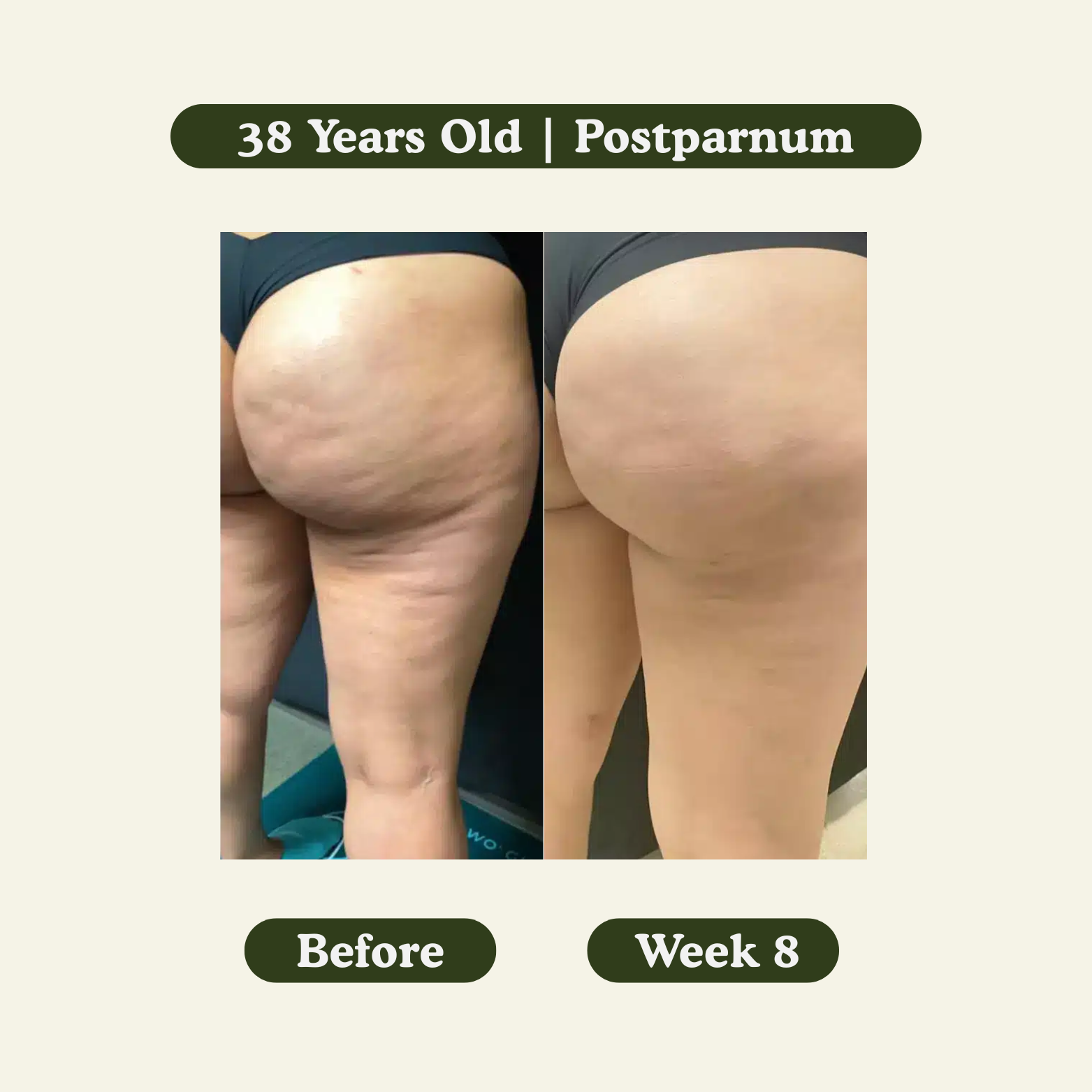 Anti-Cellulite Massage Oil